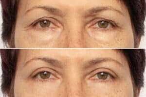 Understanding Functional Vs Cosmetic Upper Eyelid Surgery John B Holds M D F A C S Adam G